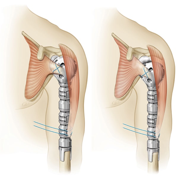 Equinoxe Humeral Reconstruction Prosthesis