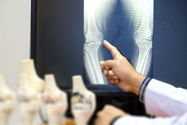 Patient Knee Xrays