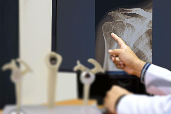 Shoulder Replacement Surgery doctors office looking at a shoulder xray